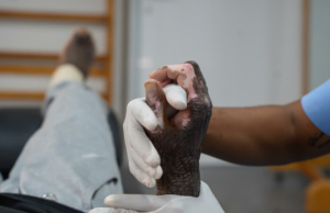 Um fisioterapeuta mobiliza a mão de um paciente com queimaduras durante uma sessão de fisioterapia no hospital da MSF em Tabarre. Port-au-Prince, Haiti, março de 2025.