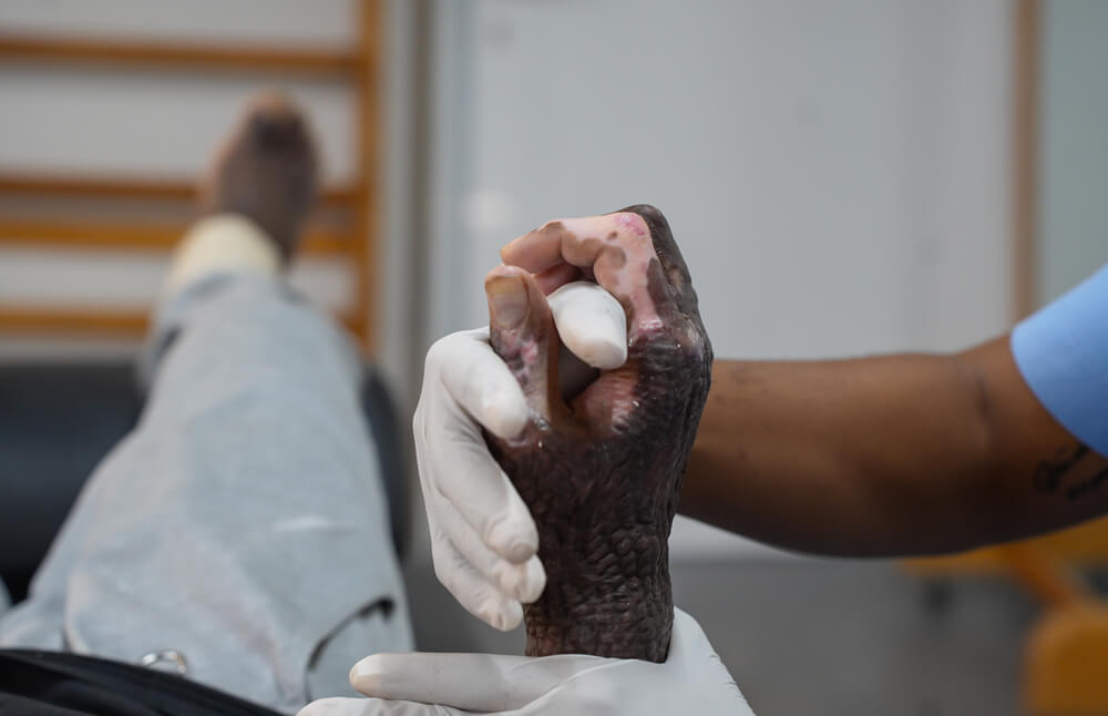 Um fisioterapeuta mobiliza a mão de um paciente com queimaduras durante uma sessão de fisioterapia no hospital da MSF em Tabarre. Port-au-Prince, Haiti, março de 2025.