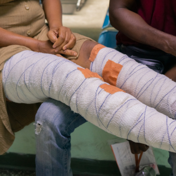 Kettly, a kindergarten teacher and entrepreneur, got burned following the explosion of a propane gas cylinder. Upon returning, she attempted to change the tube to allow gas to flow, but unfortunately, there was lit charcoal nearby, and the gas leaked, reaching the stove and spreading onto her feet. She ran away. Fortunately, her two children who were at home that day are fine. Neighbors came to help extinguish the fire. In a sudden moment of realization, she grabbed a wet towel and threw it onto the cylinder. It wasn't easy to get to the Turgeau center, but she took the risk because she needed care.